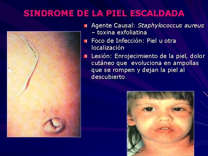 SINDROME DE LA PIEL ESCALDADA Agente Causal: Staphylococcus aureus – toxina exfoliatina Foco de