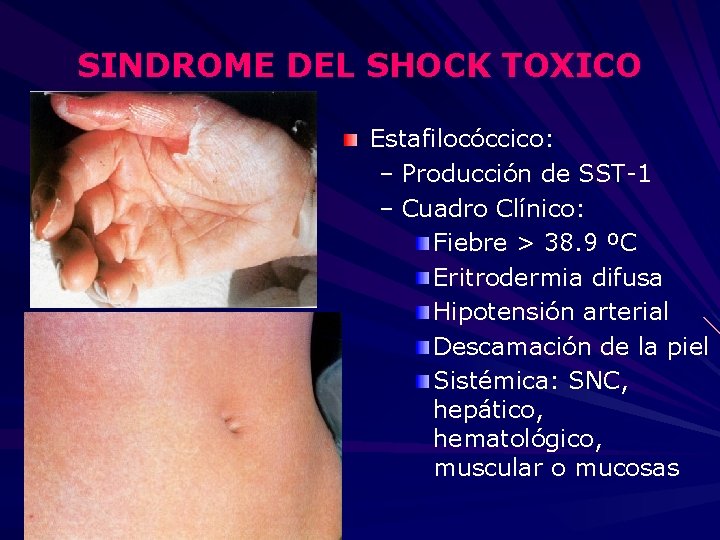 SINDROME DEL SHOCK TOXICO Estafilocóccico: – Producción de SST-1 – Cuadro Clínico: Fiebre >