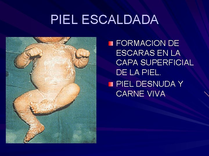 PIEL ESCALDADA FORMACION DE ESCARAS EN LA CAPA SUPERFICIAL DE LA PIEL DESNUDA Y