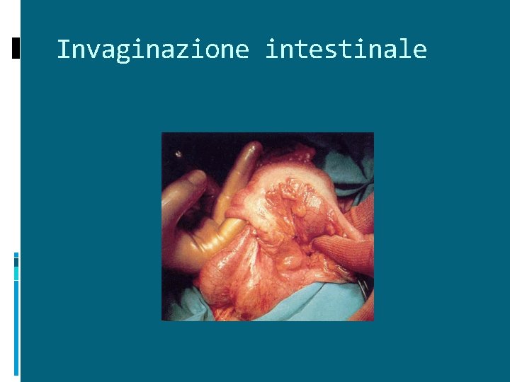 Invaginazione intestinale 