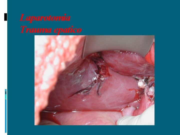 Laparotomia Trauma epatico 