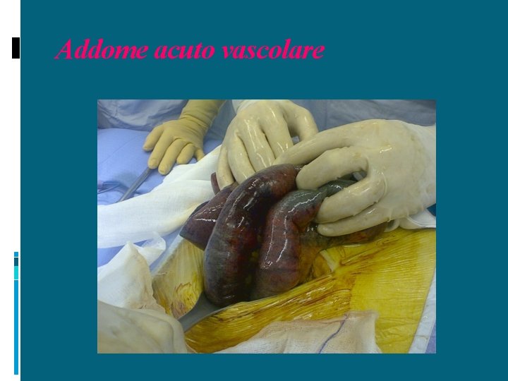 Addome acuto vascolare 