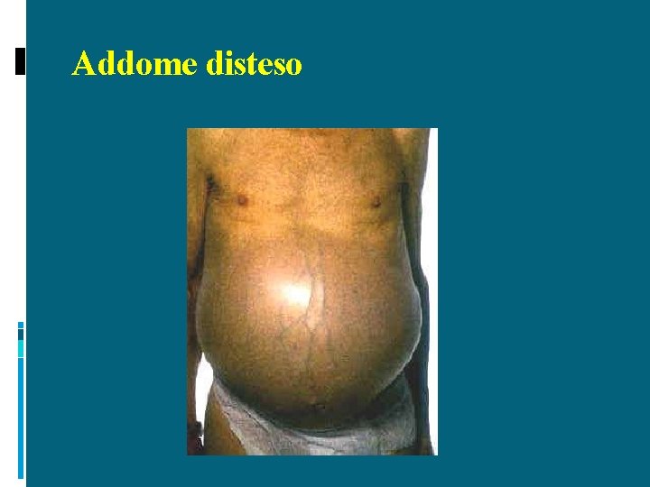 Addome disteso 