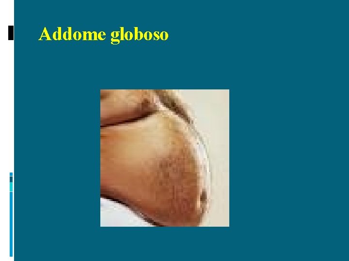 Addome globoso 