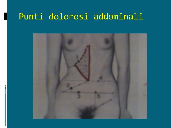 Punti dolorosi addominali 