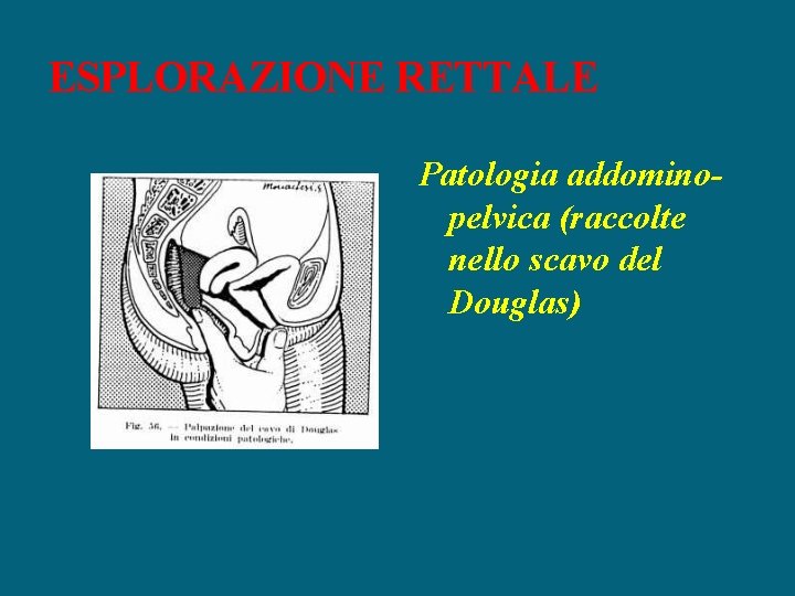 ESPLORAZIONE RETTALE Patologia addominopelvica (raccolte nello scavo del Douglas) 