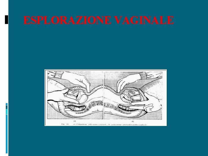 ESPLORAZIONE VAGINALE 