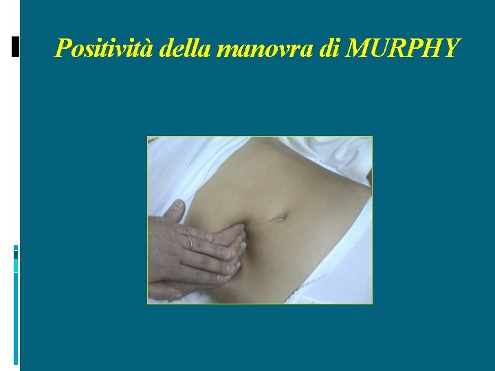 Positività della manovra di MURPHY 