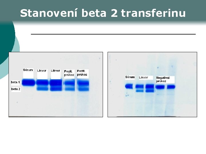 Stanovení beta 2 transferinu 