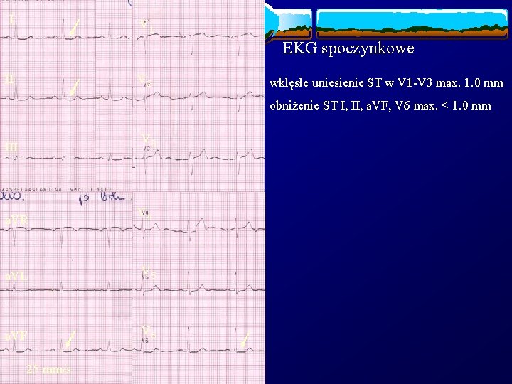 I V 1 EKG spoczynkowe II V 2 wklęsłe uniesienie ST w V 1