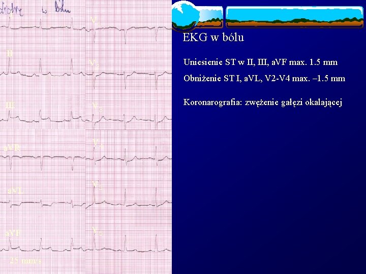 I V 1 EKG w bólu II V 2 Uniesienie ST w II, III,