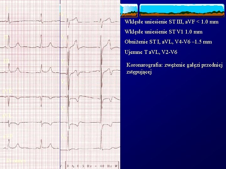 I II V 1 V 2 Wklęsłe uniesienie ST III, a. VF < 1.