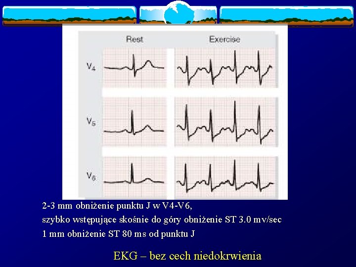 2 -3 mm obniżenie punktu J w V 4 -V 6, szybko wstępujące skośnie