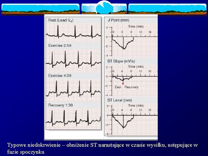 Typowe niedokrwienie – obniżenie ST narastające w czasie wysiłku, ustępujące w fazie spoczynku 