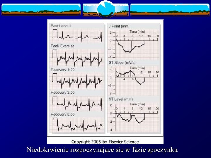 Niedokrwienie rozpoczynające się w fazie spoczynku 