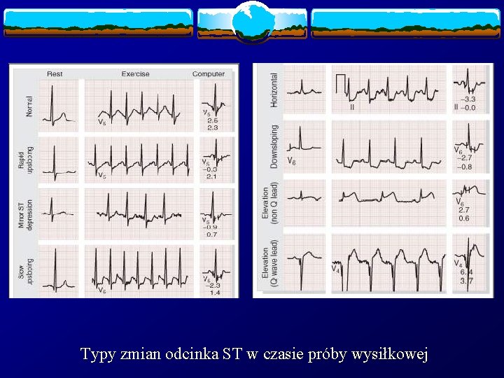 Typy zmian odcinka ST w czasie próby wysiłkowej 