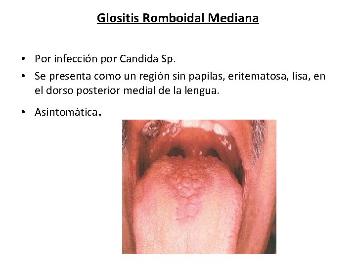 Glositis Romboidal Mediana • Por infección por Candida Sp. • Se presenta como un