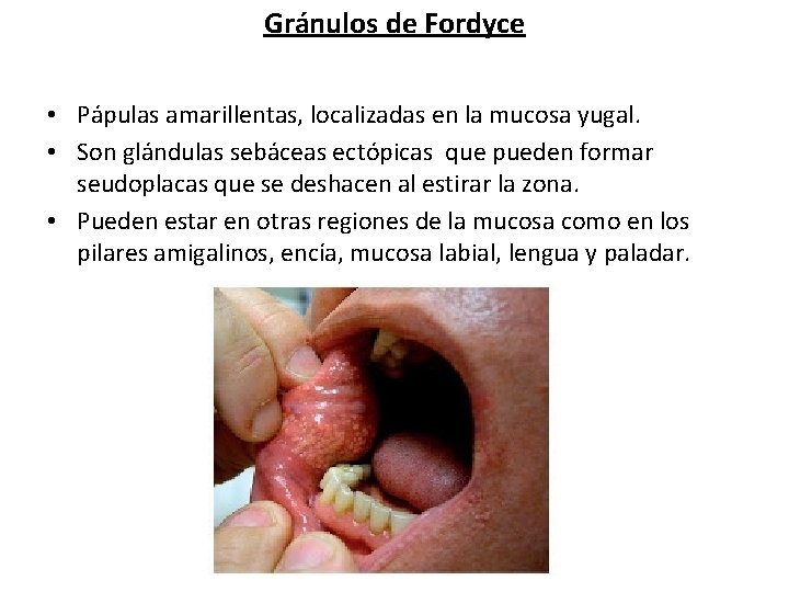 Gránulos de Fordyce • Pápulas amarillentas, localizadas en la mucosa yugal. • Son glándulas