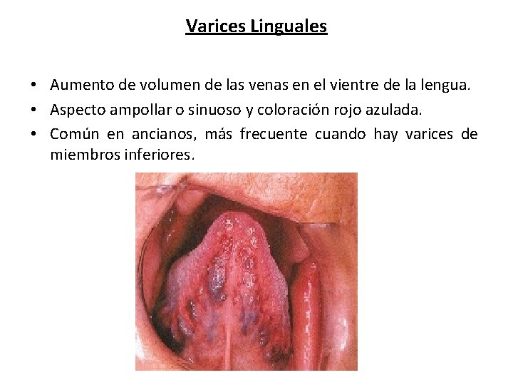 Varices Linguales • Aumento de volumen de las venas en el vientre de la