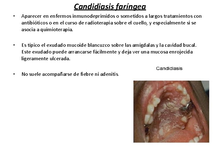 Candidiasis faríngea • Aparecer en enfermos inmunodeprimidos o sometidos a largos tratamientos con antibióticos