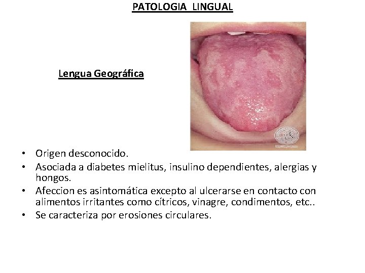 PATOLOGIA LINGUAL Lengua Geográfica • Origen desconocido. • Asociada a diabetes mielitus, insulino dependientes,