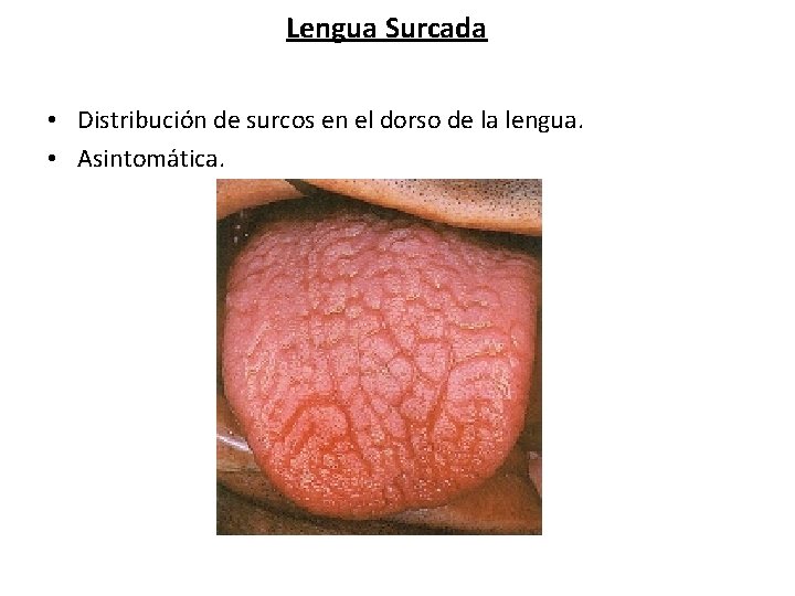Lengua Surcada • Distribución de surcos en el dorso de la lengua. • Asintomática.