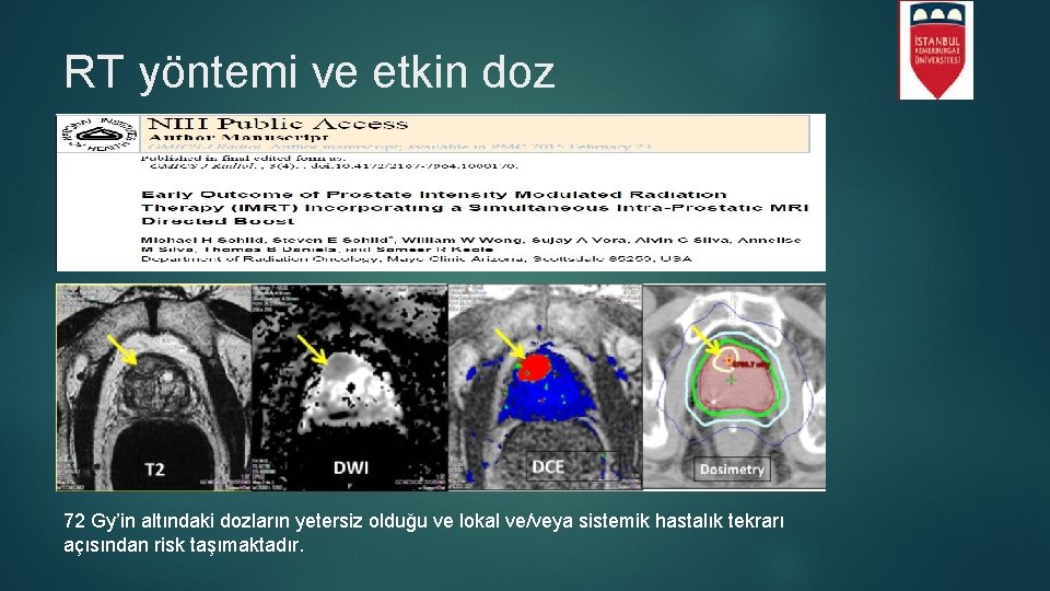 RT yöntemi ve etkin doz 72 Gy’in altındaki dozların yetersiz olduğu ve lokal ve/veya