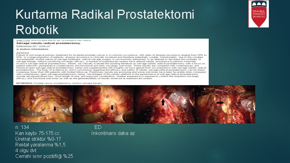 Kurtarma Radikal Prostatektomi Robotik n: 134 Kan kaybı 75 -175 cc Üretral striktür %0