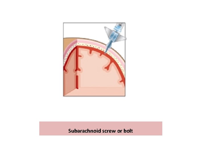 Subarachnoid screw or bolt 