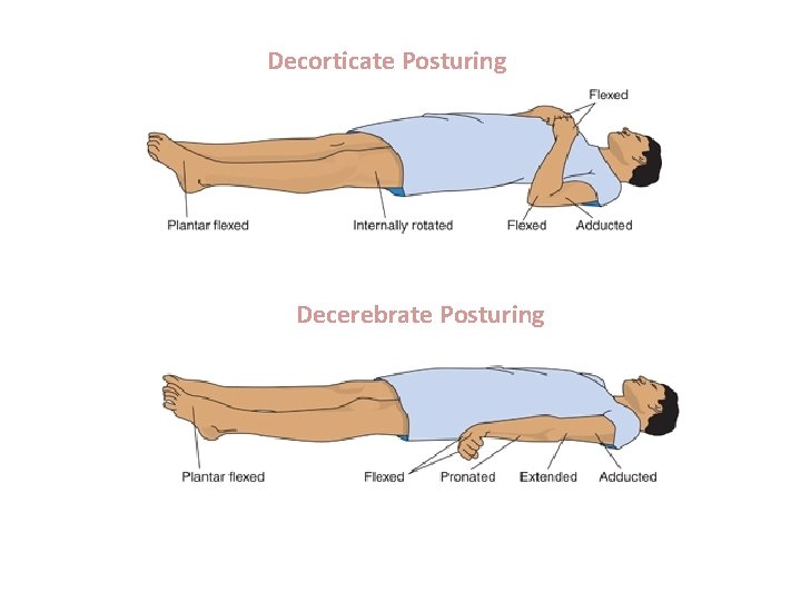 Decorticate Posturing Decerebrate Posturing 