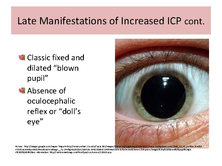 Late Manifestations of Increased ICP cont. Classic fixed and dilated “blown pupil” Absence of