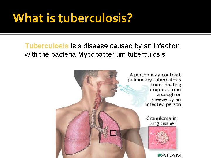 What is tuberculosis? Tuberculosis is a disease caused by an infection with the bacteria