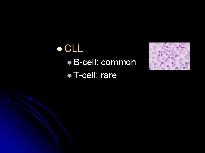 l CLL l B-cell: common l T-cell: rare 