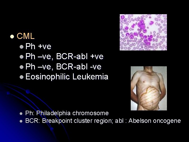 l CML l Ph +ve l Ph –ve, BCR-abl -ve l Eosinophilic Leukemia l