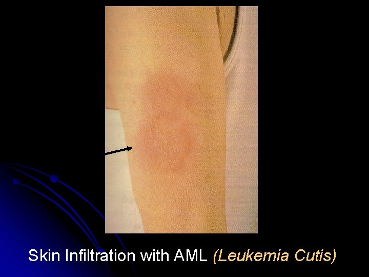 Skin Infiltration with AML (Leukemia Cutis) 