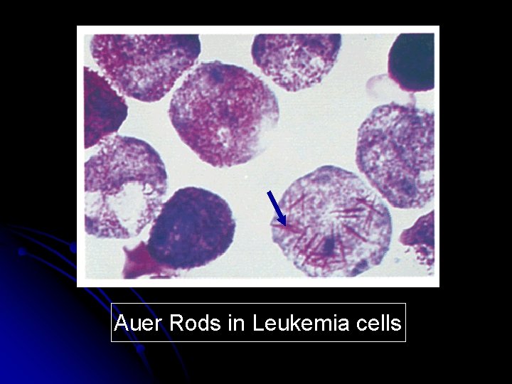 Auer Rods in Leukemia cells 