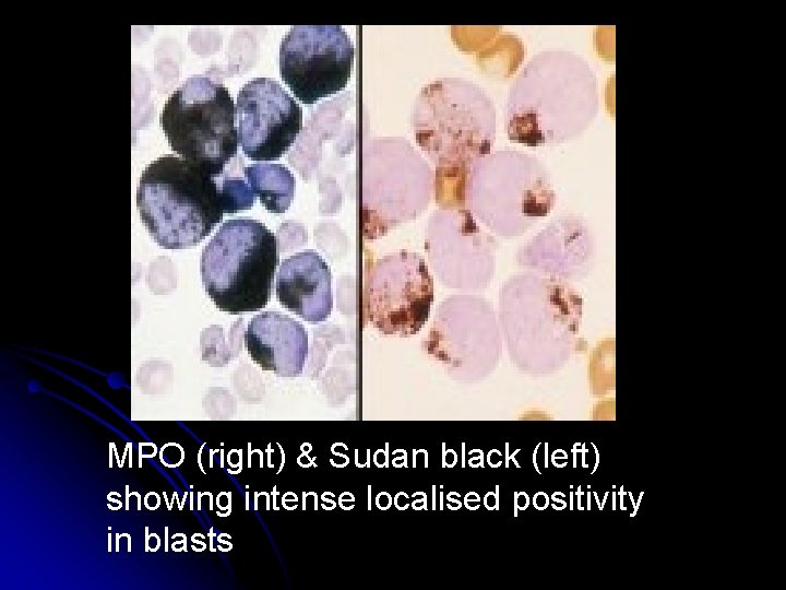 MPO (right) & Sudan black (left) showing intense localised positivity in blasts 