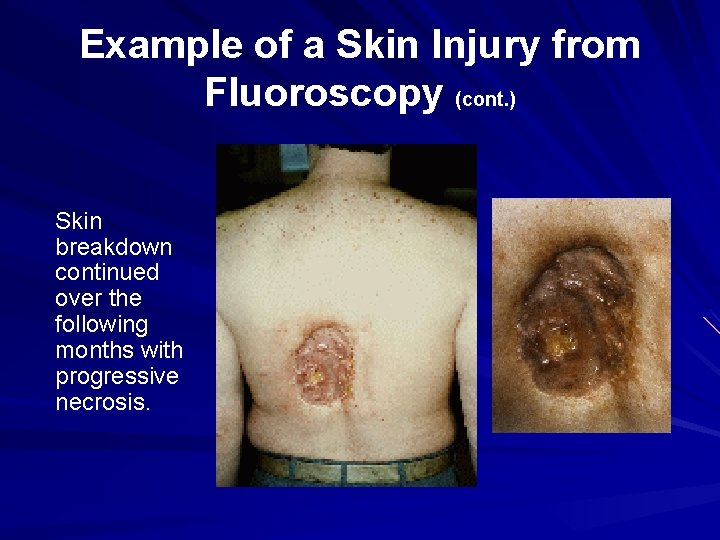 Example of a Skin Injury from Fluoroscopy (cont. ) Skin breakdown continued over the