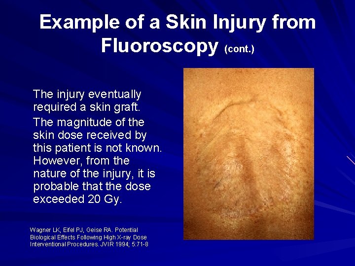 Example of a Skin Injury from Fluoroscopy (cont. ) The injury eventually required a