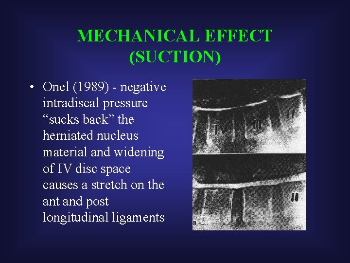 MECHANICAL EFFECT (SUCTION) • Onel (1989) - negative intradiscal pressure “sucks back” the herniated