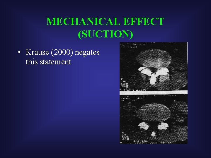 MECHANICAL EFFECT (SUCTION) • Krause (2000) negates this statement 
