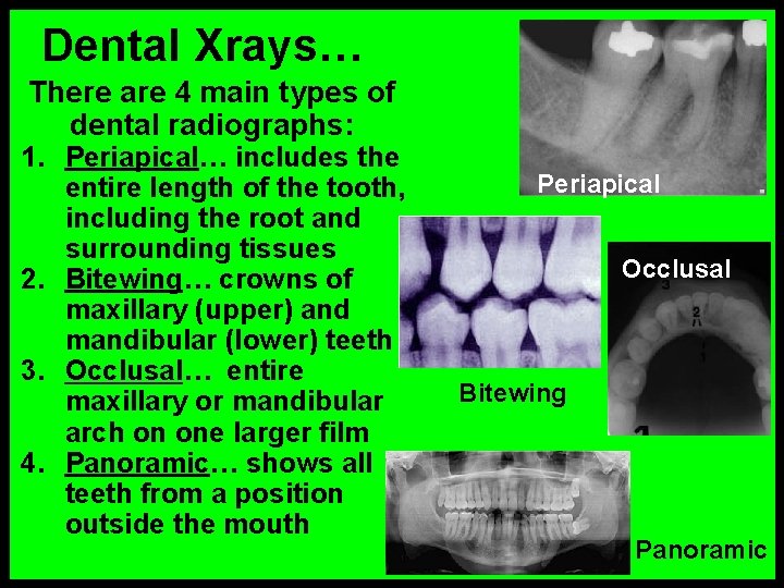 Dental Xrays… There are 4 main types of dental radiographs: 1. Periapical… includes the