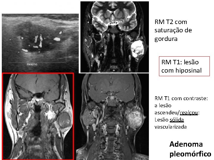 RM T 2 com saturação de gordura RM T 1: lesão com hiposinal RM