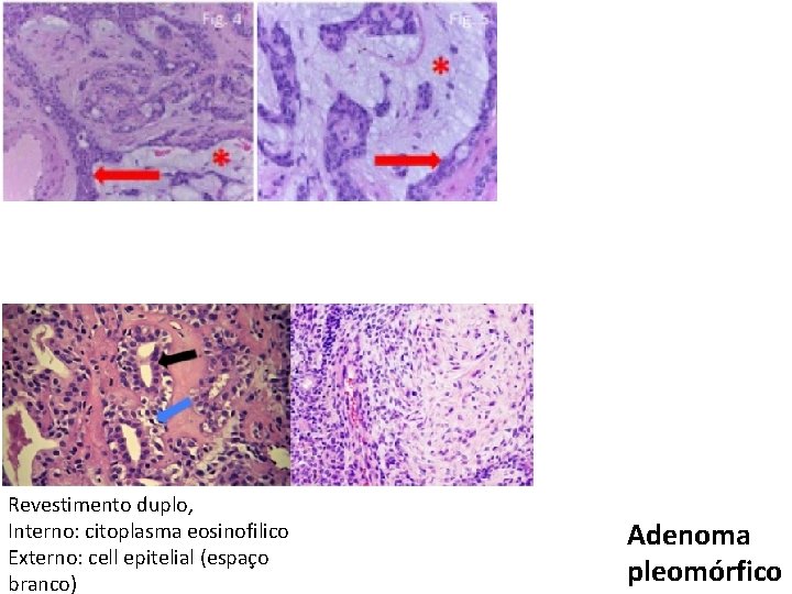 Revestimento duplo, Interno: citoplasma eosinofilico Externo: cell epitelial (espaço branco) Adenoma pleomórfico 