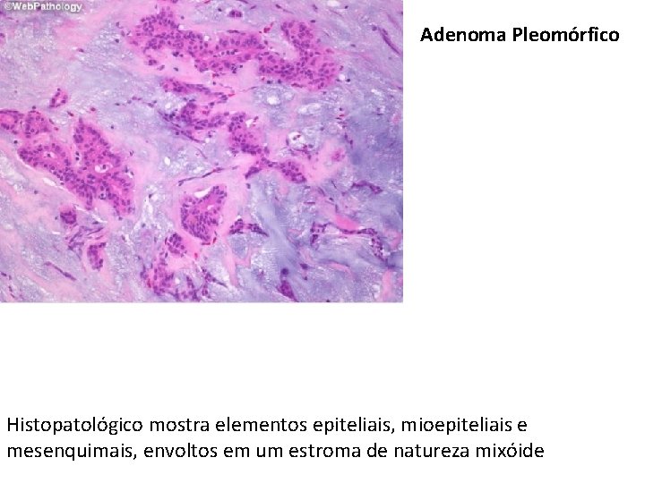 Adenoma Pleomórfico Histopatológico mostra elementos epiteliais, mioepiteliais e mesenquimais, envoltos em um estroma de