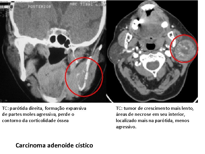 TC: parótida direita, formação expansiva de partes moles agressiva, perde o contorno da corticolidade