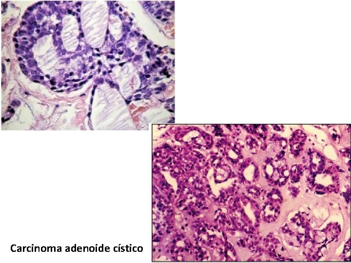 Carcinoma adenoide cístico 