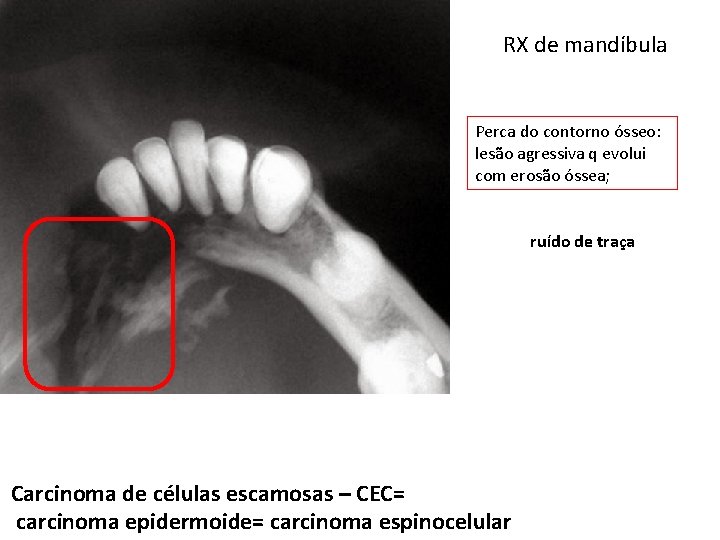 RX de mandíbula Perca do contorno ósseo: lesão agressiva q evolui com erosão óssea;