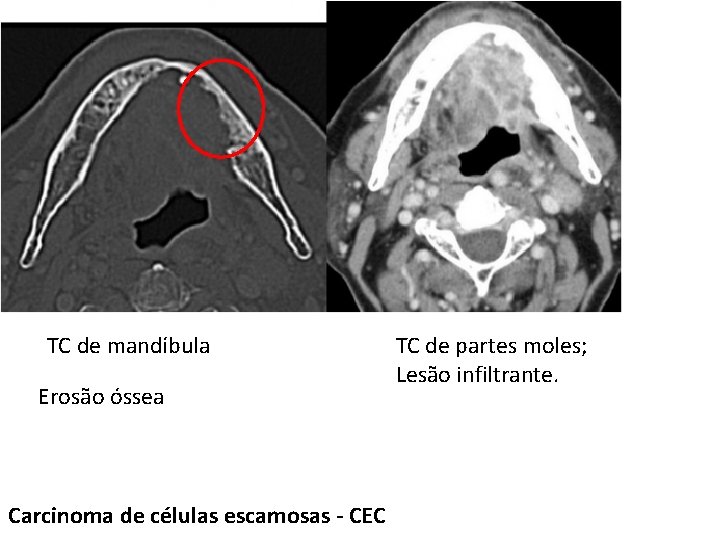 TC de mandíbula Erosão óssea Carcinoma de células escamosas - CEC TC de partes