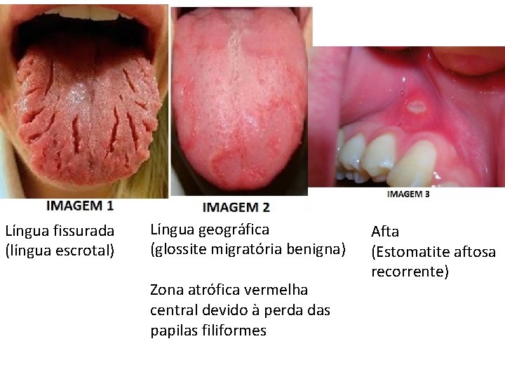 Língua fissurada (língua escrotal) Língua geográfica (glossite migratória benigna) Zona atrófica vermelha central devido